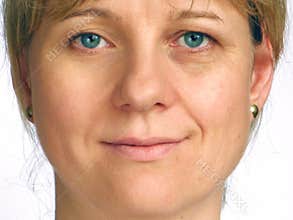 Correction of wrinkles on half of face