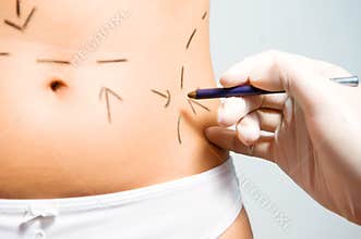 Marking abdomen for cosmetic correction surgery