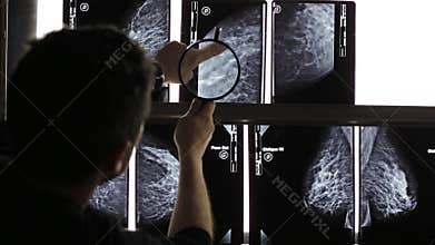 Mammogram X Ray Analysis