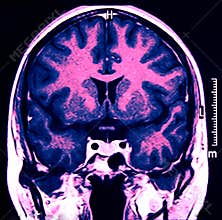 Magnetic Resonance of Brain, blue MR