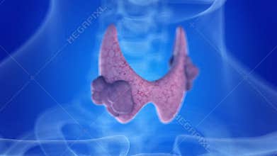 Thyroid gland cancer