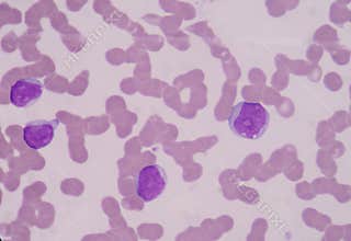 Blast cells of white blood cell.