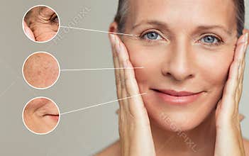 Wrinkles and skin imperfection
