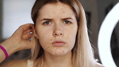 Portrait of a teenager with problem skin, close-up