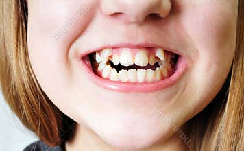 Bad teeth