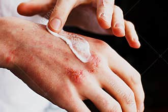 Eczema on the hands. The man applying the ointment , creams in the treatment of eczema, psoriasis and other skin