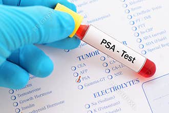 PSA test