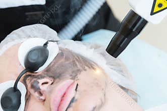 Close-up carbon face peeling procedure. Laser pulses clean skin of the face. Hardware cosmetology treatment. Process of