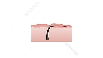 Ingrown hairs after depilation