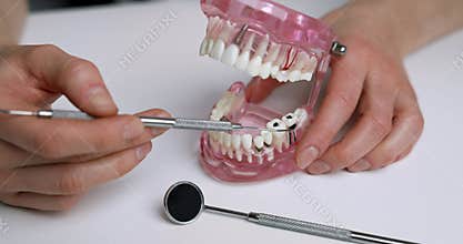 dentist showing dental problems on jaw model. tooth decay
