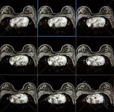 MRI of breast - breast cancer