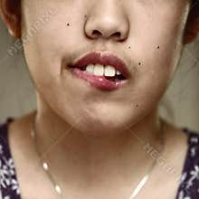 Lip biting
