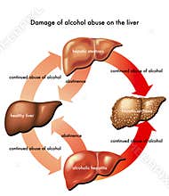 Liver and alcohol
