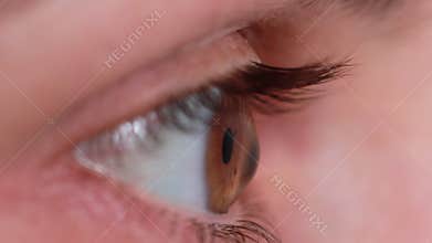 Macro eye video. Keratoconus - eye disease, thinning of the cornea in the form of a cone. The cornea plastic