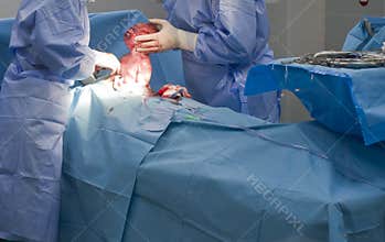 Baby being born via Caesarean Section
