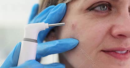 Dermatologist uses laser to remove pimple from patient face