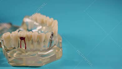 The hand of an orthodontist-dentist doctor in a green medical glove removes a dental crown from a mock-up of a dental
