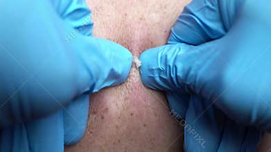 Cosmetologist removes large comedones on the patient\'s skin, blackhead removal procedure