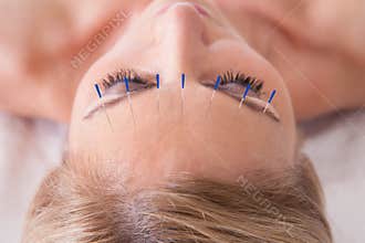 Woman receiving an acupuncture needle therapy