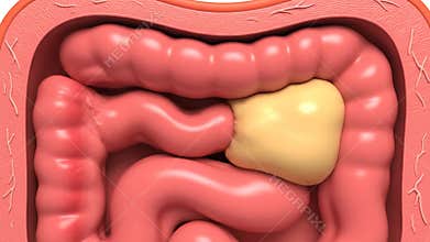 Anatomical Render of Colorectal Tumor Inside Intestine and Colon in Pink and Beige Tones for Medical Explainer Videos