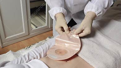 The nurse closes the bottom of the colostomy bag onto the patient's abdomen.