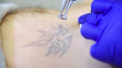 Cosmetologist doctor removes tattoo patient man professional laser.