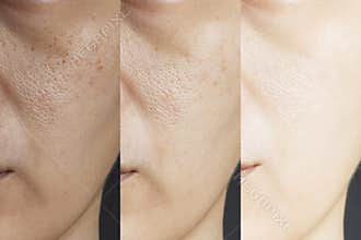 Three pictures compared effect Before and After treatment. skin with problems of freckles , pore , dull skin and wrinkles