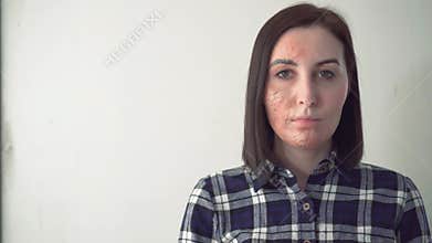Portrait of a young woman with a scar on her face
