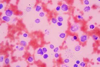 Leukemia