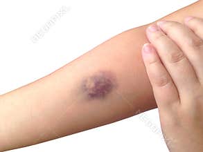 Bruises from blood collection isolated on white background.