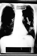 Xray of lung cancer