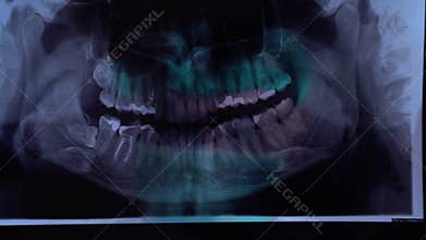 Closeup of dentist looking at dental x-ray plate examines the dental arch. X-ray image while using computer