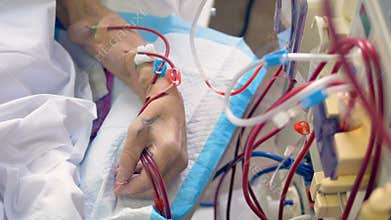 An arm with raised veins connected to a kidney machine.