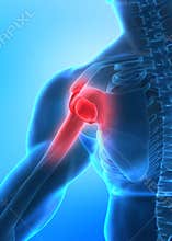 Arm pain concept