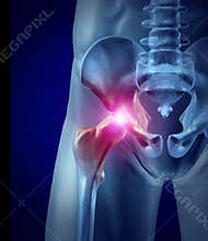Hip Pain