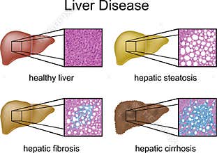 Liver Disease