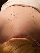 Acupuncture Concept