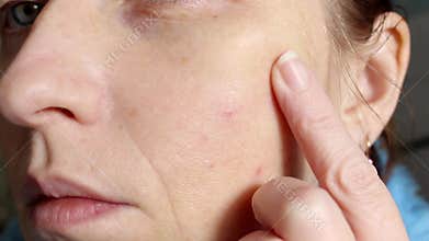 The skin of an older woman with pimples and enlarged pores. Skin care.