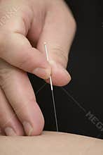 Treatment by acupuncture