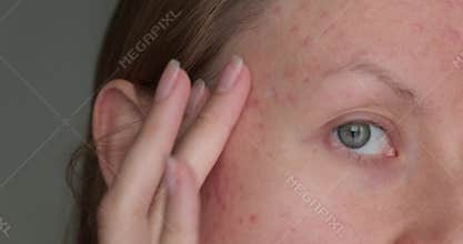 Woman touching post acne scars.
