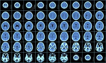 Brain CT Scan
