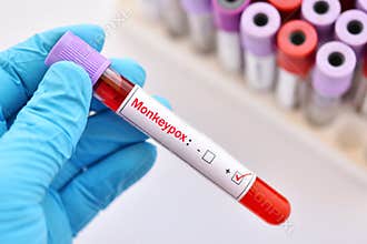 Blood sample positive with Monkeypox virus