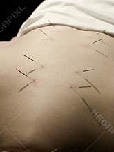 Acupuncture Concept