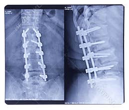 Scoliosis, X-ray