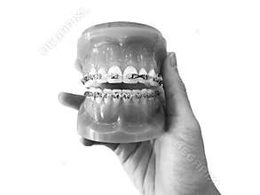 hand holding Orthodontic model bracket , medical euipment concept.