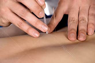 Physiotherapist doing accupuncture