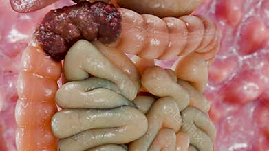 Colorectal cancer, malignant tumor in intestine, Endoscope inside colonoscopy, gut intestine