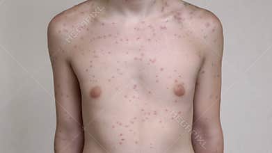 Chickenpox Rash on Body