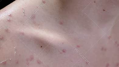 Chickenpox blisters on shoulder