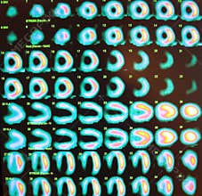 stress test,nuclear medicine
